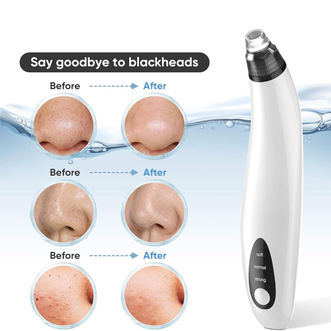 Blackhead Remover